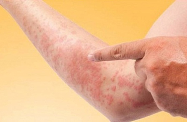 Những bệnh dễ ghé thăm bạn khi đi du lịch vào mùa thu - Ảnh 3. Những bệnh dễ ghé thăm bạn khi đi du lịch vào mùa thu - Ảnh 3.