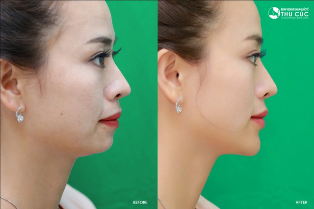 Phẫu thuật thẩm mỹ độn cằm lẹm