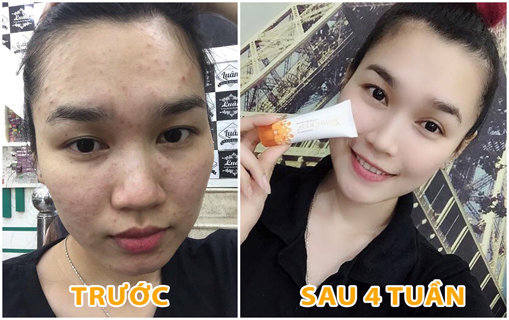 Hồ biến da sạch mụn hết thâm chỉ nhờ một bảo bối nhỏ này đây! - Ảnh 6. Hồ biến da sạch mụn hết thâm chỉ nhờ một bảo bối nhỏ này đây! - Ảnh 6.