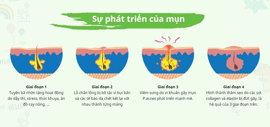 Hóng bí quyết trị mụn chưa đến 50k an toàn mà hiệu quả đang gây sốt giới trẻ - Ảnh 9. Hóng bí quyết trị mụn chưa đến 50k an toàn mà hiệu quả đang gây sốt giới trẻ - Ảnh 9.