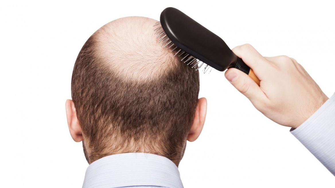 Tóc rụng nhiều, đây là cách đơn giản để tránh bị hói đầu cho cả nam và nữ - Ảnh 2. Tóc rụng nhiều, đây là cách đơn giản để tránh bị hói đầu cho cả nam và nữ - Ảnh 2.