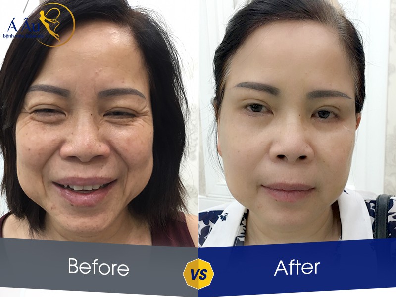 Giải mã cơn sốt Căng da chỉ vàng: Phép màu “lão hóa ngược” trong 1 giờ - Ảnh 2. Giải mã cơn sốt Căng da chỉ vàng: Phép màu “lão hóa ngược” trong 1 giờ - Ảnh 2.