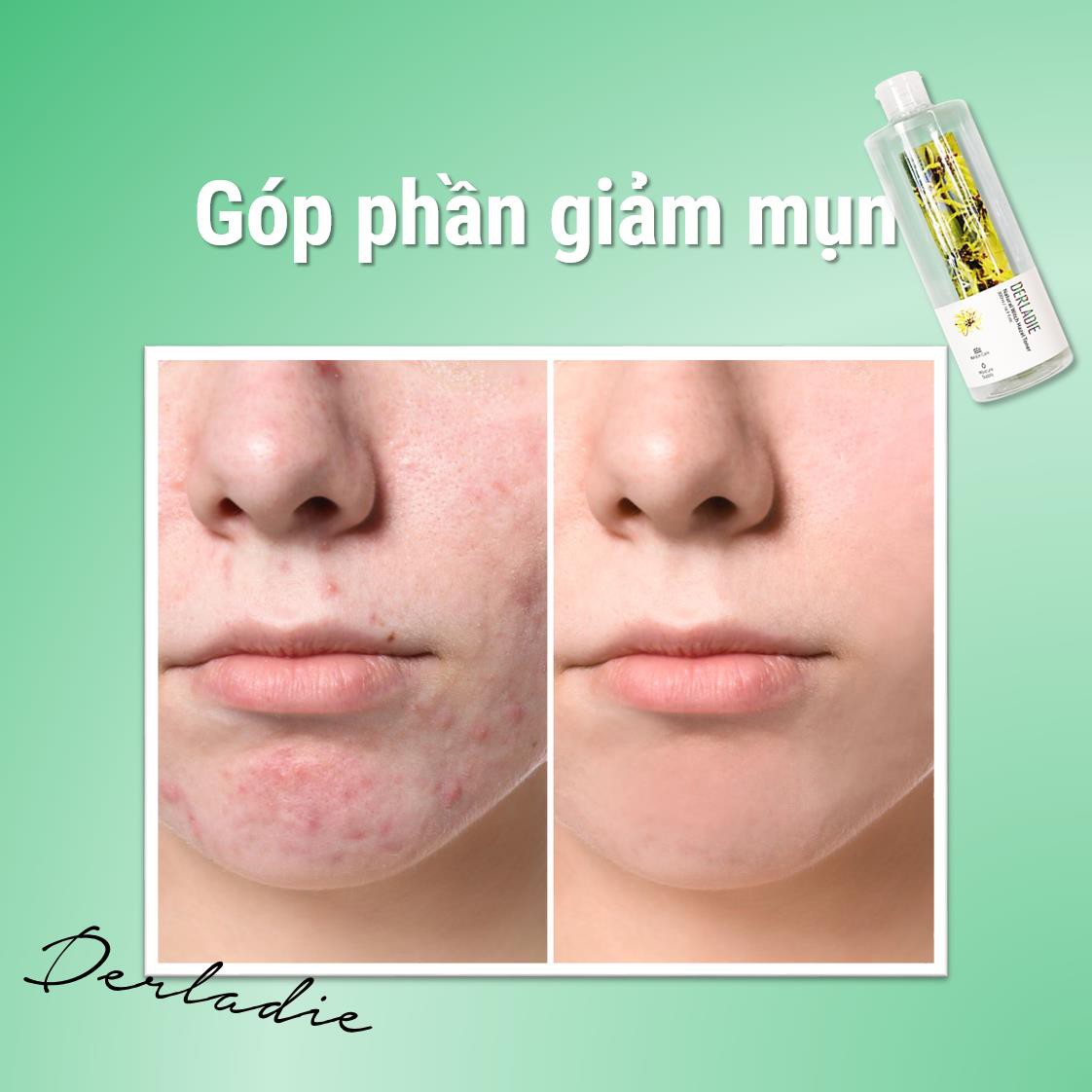 Bắt trend 2019: Ngăn ngừa mụn chỉ với một lọ toner, tưởng đùa hóa ra là thật? - Ảnh 3. Bắt trend 2019: Ngăn ngừa mụn chỉ với một lọ toner, tưởng đùa hóa ra là thật? - Ảnh 3.