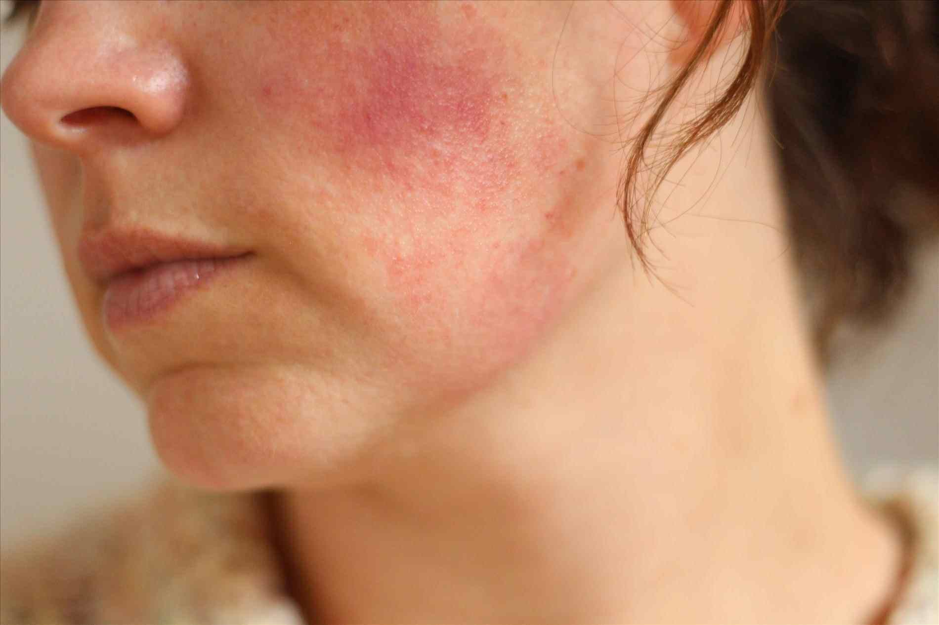 Những sai lầm thường gặp khiến da nhiễm Corticoid trở nên tồi tệ hơn - Ảnh 1. Những sai lầm thường gặp khiến da nhiễm Corticoid trở nên tồi tệ hơn - Ảnh 1.