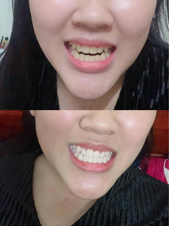 Tin lời thần tượng tự mua gel tẩy trắng răng tại nhà về dùng, cô gái nhận cái kết ngỡ ngàng sau 1 tuần - Ảnh 1. Tin lời thần tượng tự mua gel tẩy trắng răng tại nhà về dùng, cô gái nhận cái kết ngỡ ngàng sau 1 tuần - Ảnh 1.