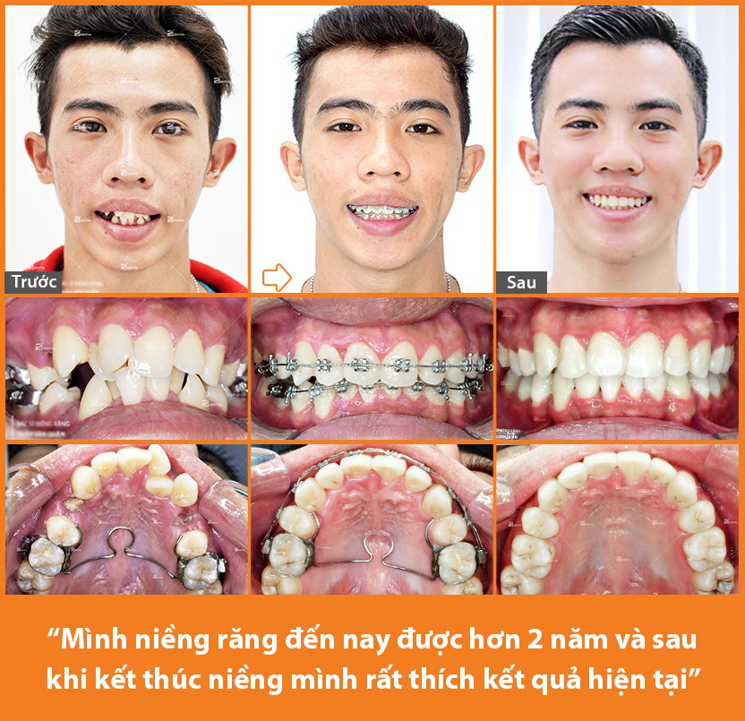 Nhật ký niềng răng 2 năm của chàng PT 24 tuổi tại nha khoa chuyên niềng răng Up Dental - Ảnh 2. Nhật ký niềng răng 2 năm của chàng PT 24 tuổi tại nha khoa chuyên niềng răng Up Dental - Ảnh 2.