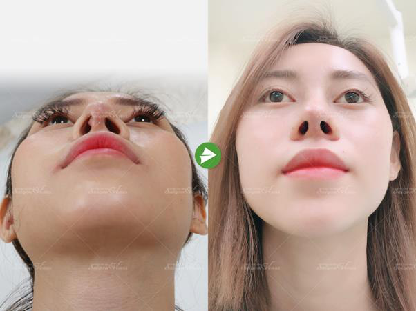 Nâng mũi sụn sườn Fascia: Xu hướng thẩm mỹ mũi được nhiều hot girl, TikToker lựa chọn - Ảnh 1.