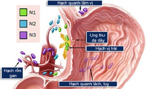 Những điều cần biết giúp giới văn phòng thoát” bệnh ung thư dạ dày - Ảnh 2.