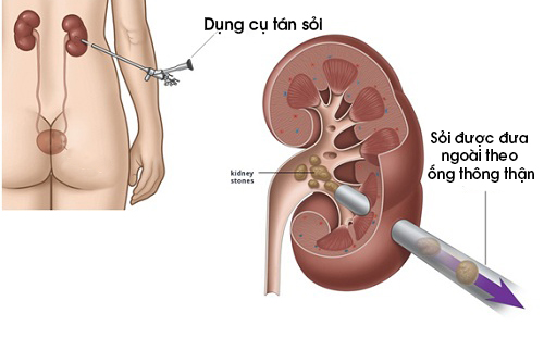 Điều trị sỏi thận từ đơn giản đến phức tạp - Ảnh 1.