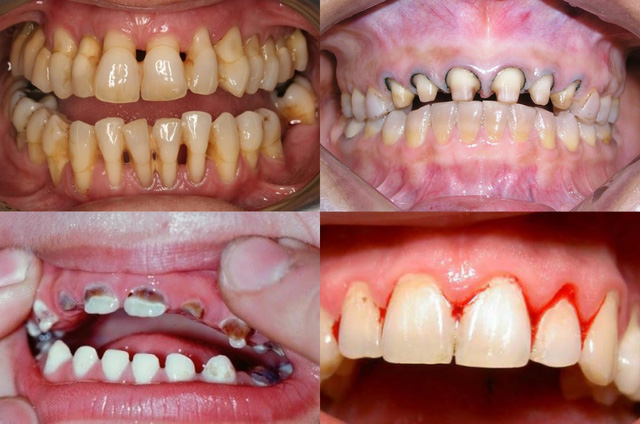 7 điều quan trọng cần biết trước khi làm răng sứ thẩm mỹ - Ảnh 3.