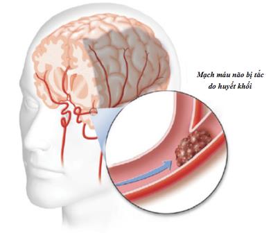 Vai trò của tỏi đen trong việc dự phòng tai biến mạch máu não - Ảnh 1.