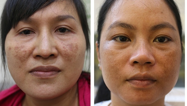 Nguy&ecirc;n nh&acirc;n v&agrave; c&aacute;ch điều trị n&aacute;m sau sinh - Ảnh 1.