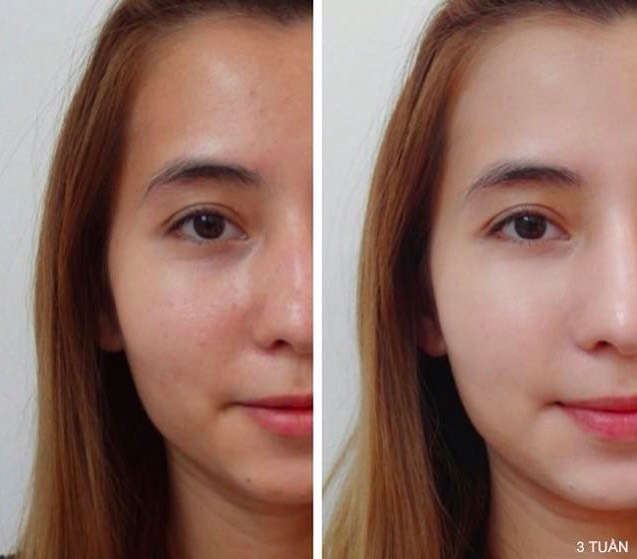 Bí quyết trẻ ra hơn 5 tuổi ngay lần đầu không cần phẫu thuật - Ảnh 4. Bí quyết trẻ ra hơn 5 tuổi ngay lần đầu không cần phẫu thuật - Ảnh 4.
