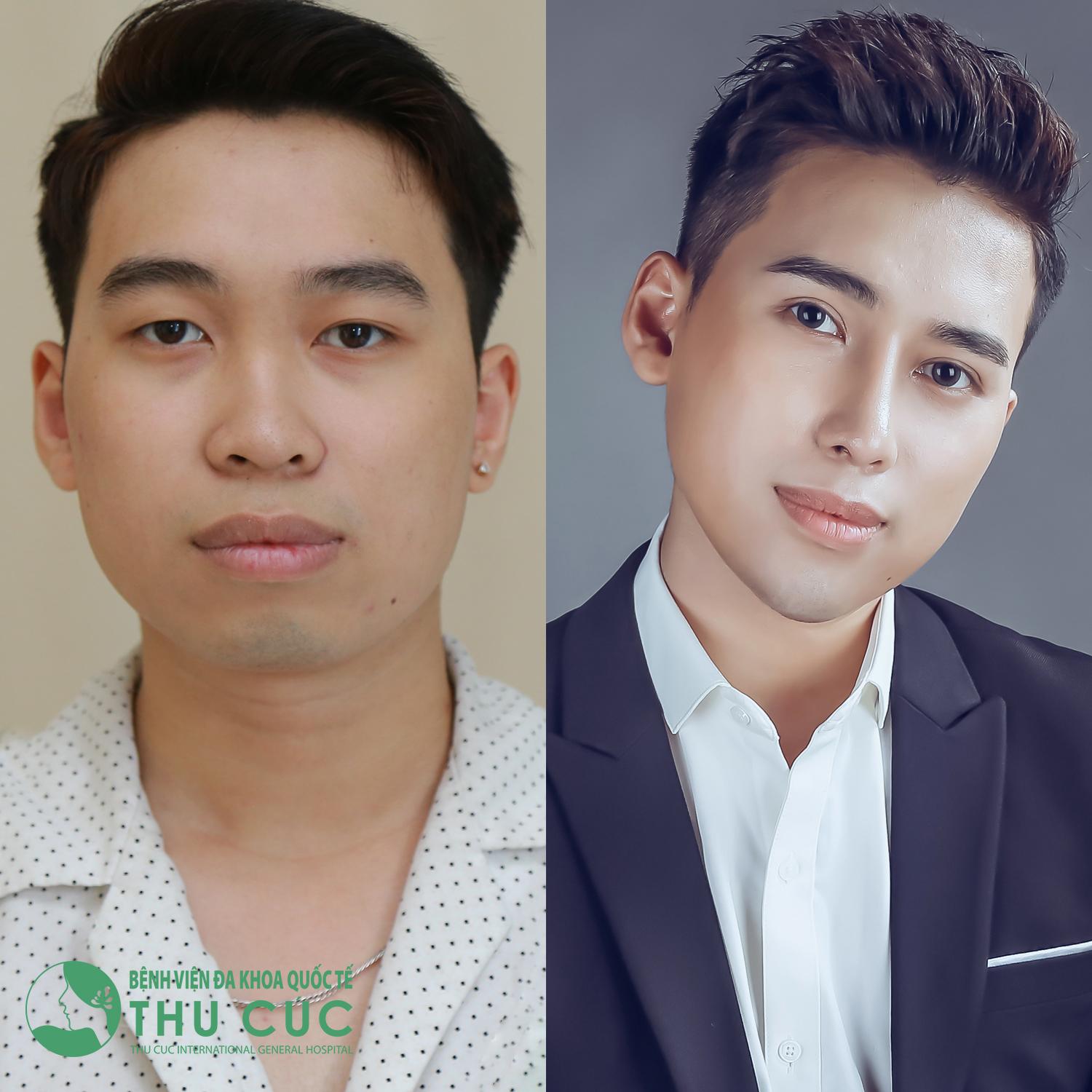 Top 3 VietNam Idol lột xác hoàn hảo sau phẫu thuật thẩm mỹ - Ảnh 6. Top 3 VietNam Idol lột xác hoàn hảo sau phẫu thuật thẩm mỹ - Ảnh 6.