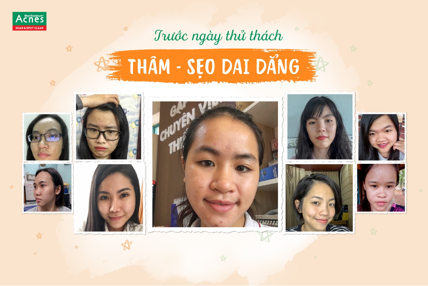 Cùng Acnes nhìn lại hành trình đáng nhớ của 14 ngày thử thách sáng thâm - mờ sẹo - Ảnh 2. Cùng Acnes nhìn lại hành trình đáng nhớ của 14 ngày thử thách sáng thâm - mờ sẹo - Ảnh 2.