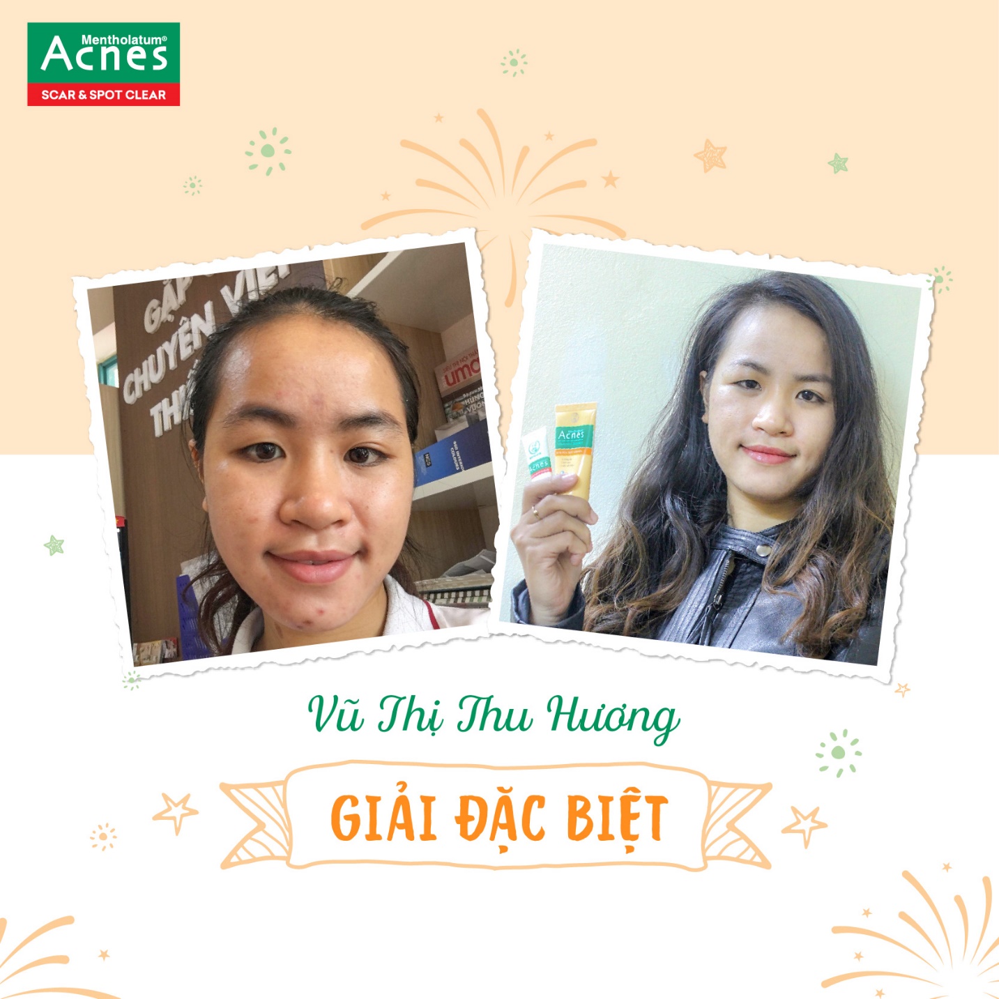 Cùng Acnes nhìn lại hành trình đáng nhớ của 14 ngày thử thách sáng thâm - mờ sẹo - Ảnh 5. Cùng Acnes nhìn lại hành trình đáng nhớ của 14 ngày thử thách sáng thâm - mờ sẹo - Ảnh 5.