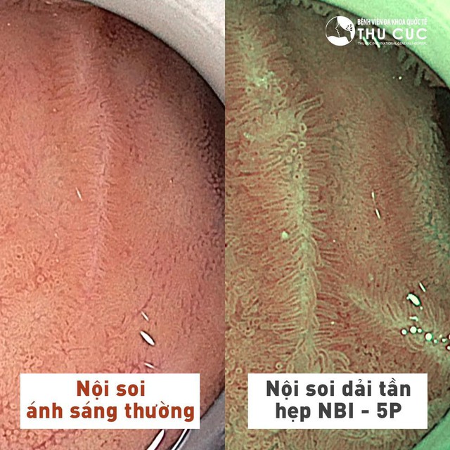 Thu C&uacute;c ưu đ&atilde;i đến 30% nội soi kh&ocirc;ng đau &ndash; si&ecirc;u ph&oacute;ng đại &ndash; quan s&aacute;t s&acirc;u - Ảnh 1.