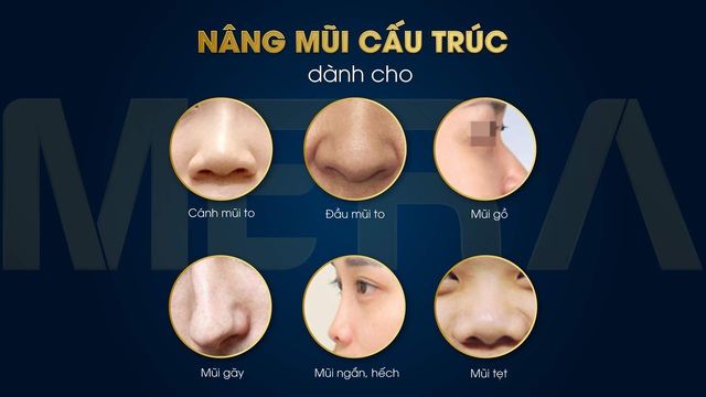 Nền mũi - yếu tố quan trọng khi phẫu thuật thẩm mỹ - Ảnh 2.