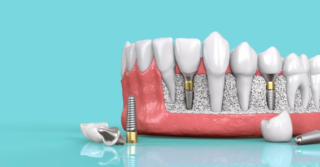 Mất răng nên trồng răng Implant hay làm cầu răng sứ? - Ảnh 1.