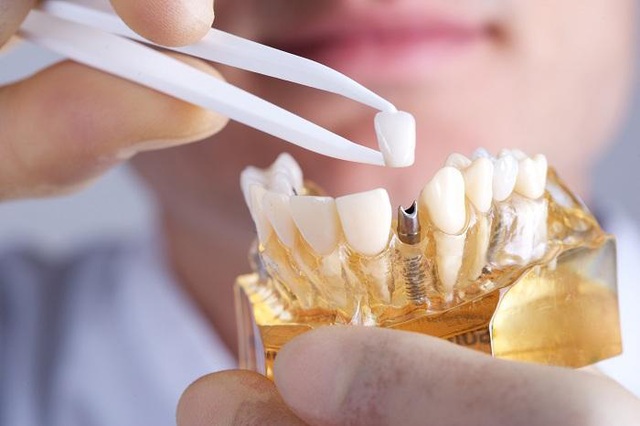 Mất răng nên trồng răng Implant hay làm cầu răng sứ? - Ảnh 2.