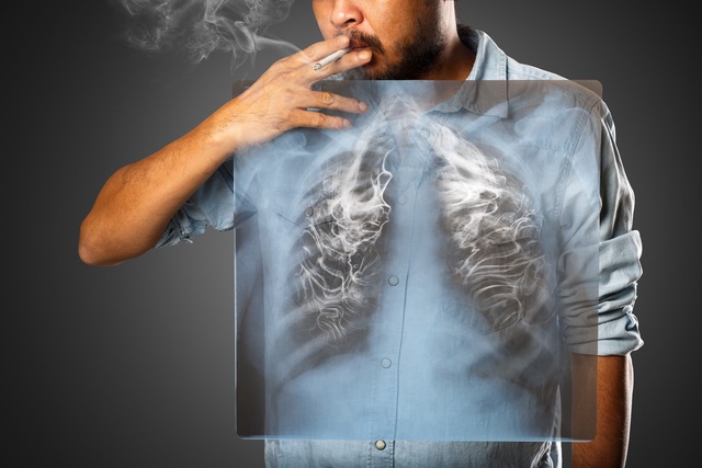 U phổi: Căn bệnh đang ngày một tăng nhanh - Ảnh 1.