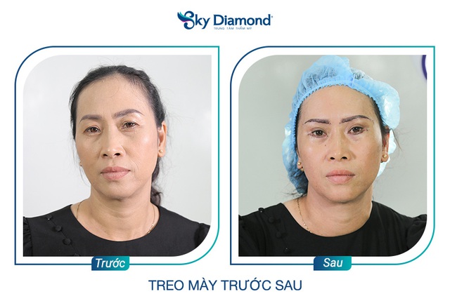 Làm sao để tiết kiệm được chi phí khi treo mày? - Ảnh 4.