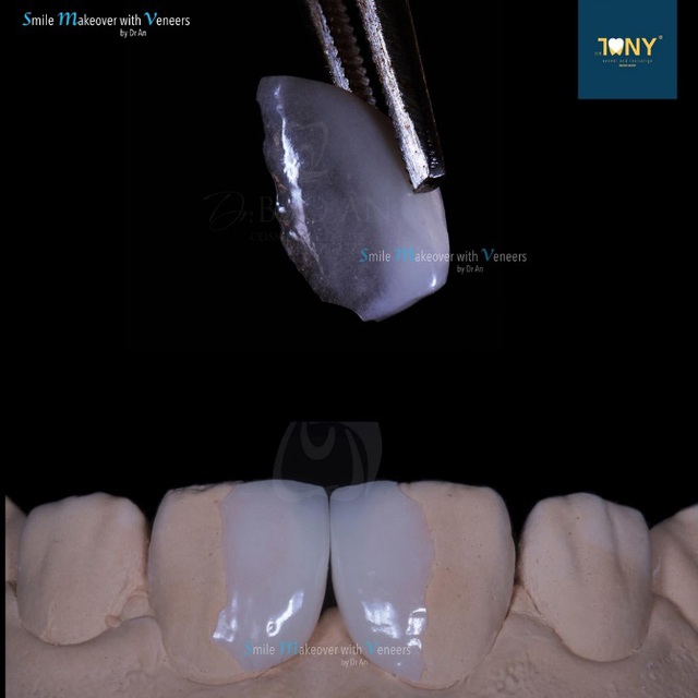 Các phương pháp làm răng thẩm mỹ mới - Ảnh 3.