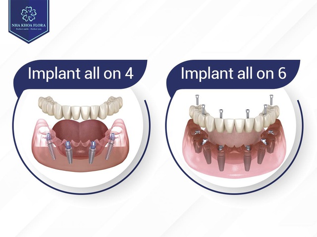 Khi nào bạn cần cấy ghép implant all on 4 - Ảnh 1. Khi nào bạn cần cấy ghép implant all on 4 - Ảnh 1.