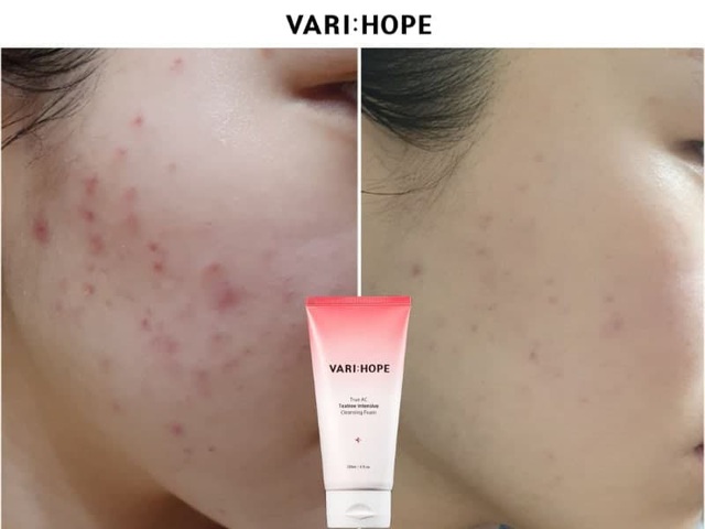 Dùng thử sữa rửa mặt đang được nhiều chị em bàn tán, cuối cùng tôi cũng tìm được “chân ái” cho da mụn và nhạy cảm của mình - Ảnh 6.