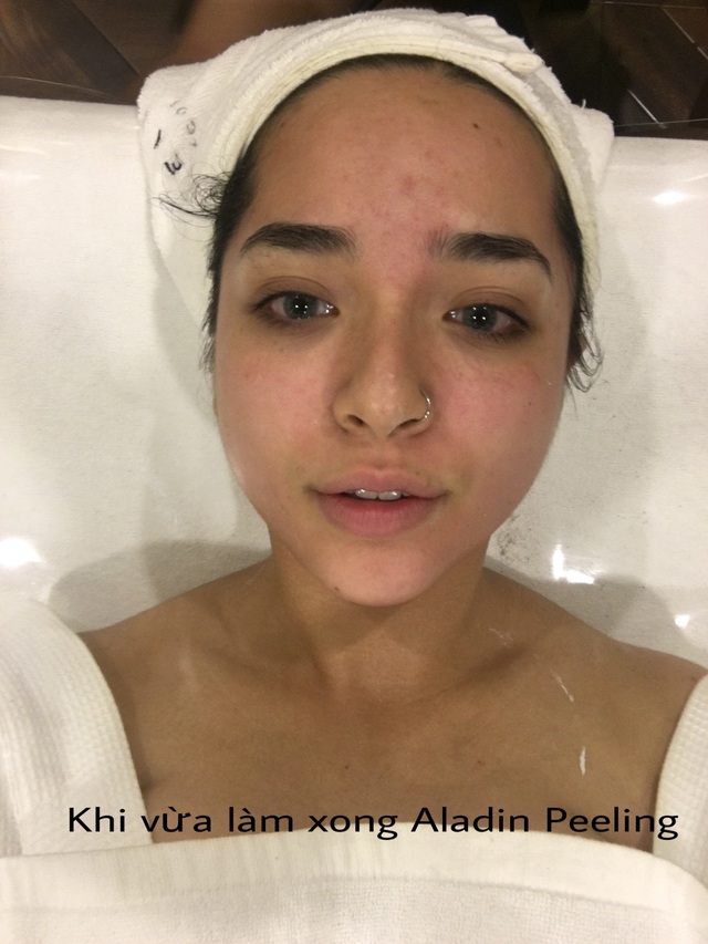 &ldquo;Qu&eacute;t sạch mụn hiệu quả với phương ph&aacute;p Aladin Peeling - Ảnh 1.