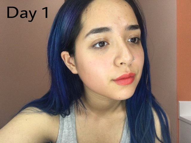 &ldquo;Qu&eacute;t sạch mụn hiệu quả với phương ph&aacute;p Aladin Peeling - Ảnh 2.