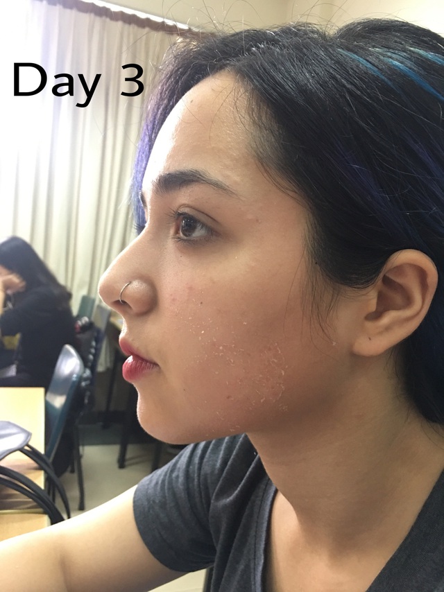 &ldquo;Qu&eacute;t sạch mụn hiệu quả với phương ph&aacute;p Aladin Peeling - Ảnh 5.