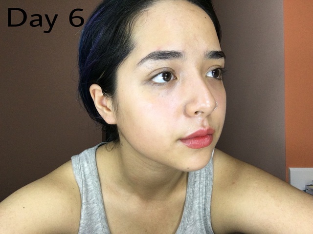 &ldquo;Qu&eacute;t sạch mụn hiệu quả với phương ph&aacute;p Aladin Peeling - Ảnh 8.