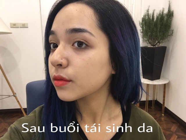 &ldquo;Qu&eacute;t sạch mụn hiệu quả với phương ph&aacute;p Aladin Peeling - Ảnh 10.