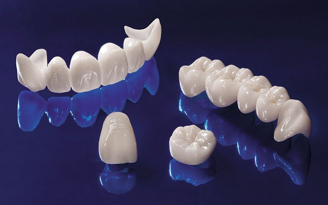 7 điều quan trọng cần biết trước khi làm răng sứ thẩm mỹ - Ảnh 1.