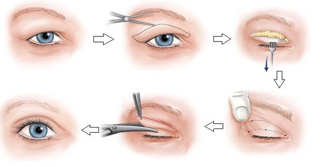 Công nghệ biến nàng “mắt hí” trở nên xinh đẹp và tự tin bội phần - Ảnh 3. Công nghệ biến nàng “mắt hí” trở nên xinh đẹp và tự tin bội phần - Ảnh 3.