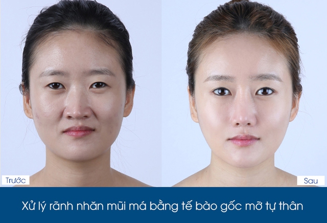 Cấy mỡ mặt Baby Face bằng tế bào gốc tự thân ưu đãi lên đến 400 triệu - Ảnh 3.
