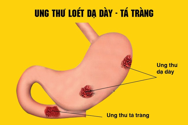 Uống nghệ là bao tử hết đau, liệu có đúng không ? - Ảnh 1.