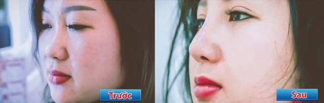 Nếu đang có ý định nâng mũi: Bạn nhất định phải biết những điều này! - Ảnh 6. Nếu đang có ý định nâng mũi: Bạn nhất định phải biết những điều này! - Ảnh 6.