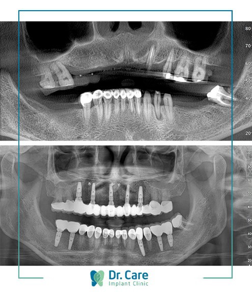 Chọn trồng răng Implant vì chán cảnh làm lại răng sứ - Ảnh 4.