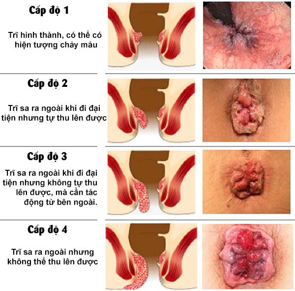 Thực phẩm bảo vệ sức khỏe TRISELAN+ giải pháp hỗ trợ điều trị triệu chứng Trĩ, Táo Bón và Suy Giãn Tĩnh Mạch - Ảnh 1.