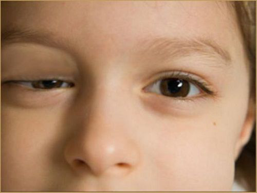Chữa sụp mí mắt bằng Đông y: Phương pháp an toàn và hiệu quả - Ảnh 1.