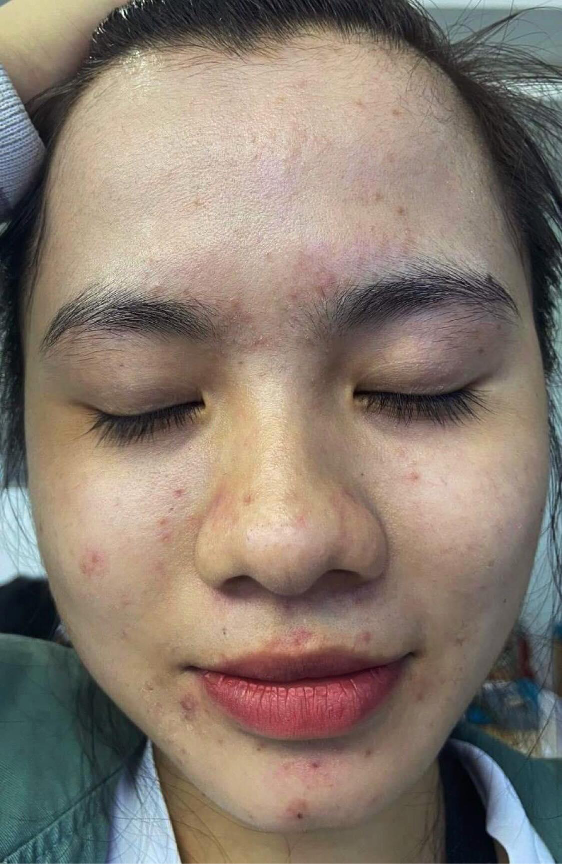 Nữ sinh Y khoa Cần Thơ thú nhận những sai lầm trong trị mụn và chốt hạ mụn viêm, mụn ẩn sau 3 tháng - Ảnh 1. Nữ sinh Y khoa Cần Thơ thú nhận những sai lầm trong trị mụn và chốt hạ mụn viêm, mụn ẩn sau 3 tháng - Ảnh 1.