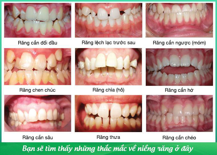 Suni Hạ Linh chia sẻ về quá trình niềng răng của bản thân tại buổi ra mắt sách - Ảnh 2.