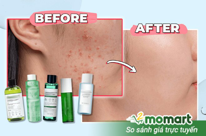 Hướng dẫn c&aacute;ch chọn toner cho da dầu v&agrave; da dầu mụn ph&ugrave; hợp - Ảnh 3.