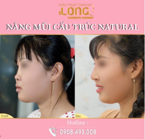 Mách bạn địa chỉ uy tín nâng mũi cấu trúc natural: Biến hình chiếc mũi đầy khuyết điểm trở nên đẹp tự nhiên mà hiệu quả lâu dài - Ảnh 4. Mách bạn địa chỉ uy tín nâng mũi cấu trúc natural: Biến hình chiếc mũi đầy khuyết điểm trở nên đẹp tự nhiên mà hiệu quả lâu dài - Ảnh 4.