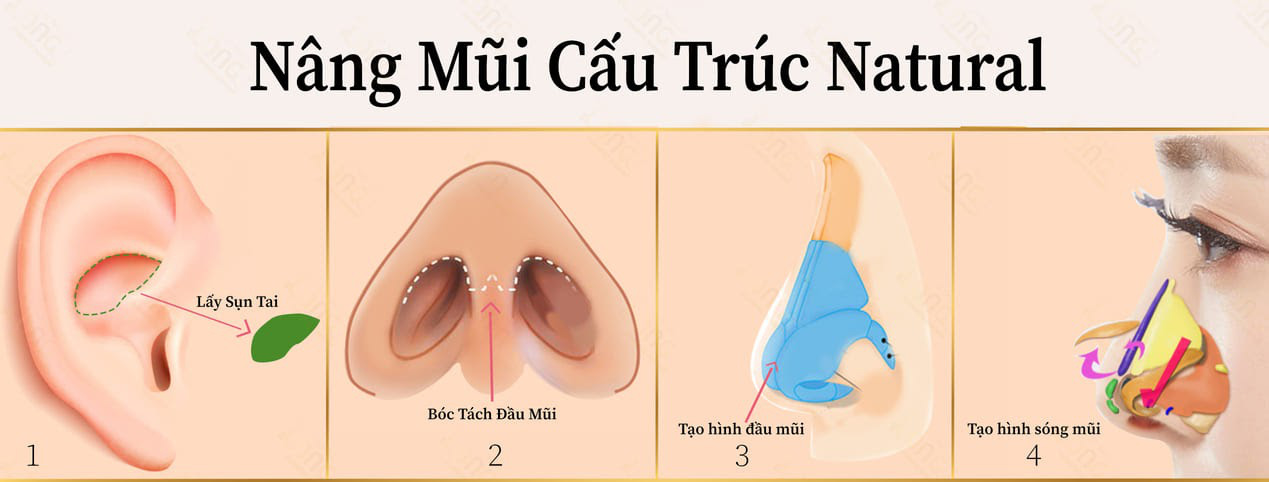 Mách bạn địa chỉ uy tín nâng mũi cấu trúc natural: Biến hình chiếc mũi đầy khuyết điểm trở nên đẹp tự nhiên mà hiệu quả lâu dài - Ảnh 2. Mách bạn địa chỉ uy tín nâng mũi cấu trúc natural: Biến hình chiếc mũi đầy khuyết điểm trở nên đẹp tự nhiên mà hiệu quả lâu dài - Ảnh 2.