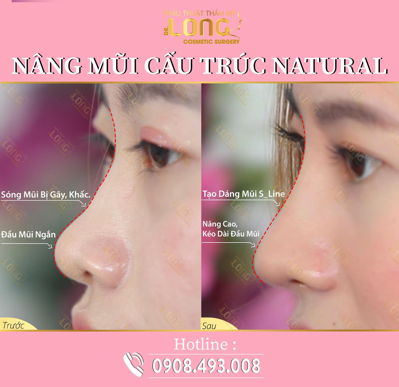 Mách bạn địa chỉ uy tín nâng mũi cấu trúc natural: Biến hình chiếc mũi đầy khuyết điểm trở nên đẹp tự nhiên mà hiệu quả lâu dài - Ảnh 3. Mách bạn địa chỉ uy tín nâng mũi cấu trúc natural: Biến hình chiếc mũi đầy khuyết điểm trở nên đẹp tự nhiên mà hiệu quả lâu dài - Ảnh 3.