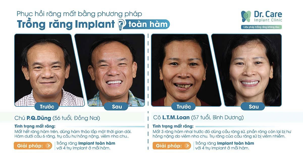 Giá trồng răng Implant - Mất răng có nên trồng Implant sớm? - Ảnh 3.