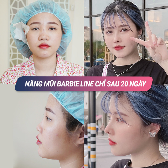 B&aacute;c sĩ Trần Do&atilde;n L&acirc;m giải đ&aacute;p về hiệu quả của n&acirc;ng mũi sụn sườn tự th&acirc;n - Ảnh 5.